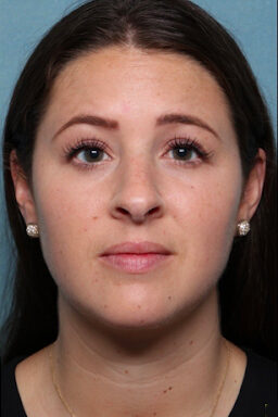 Case # 23 after photo