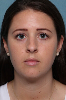 Case # 23 before photo