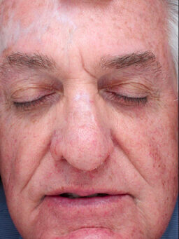 Case # 32 after photo