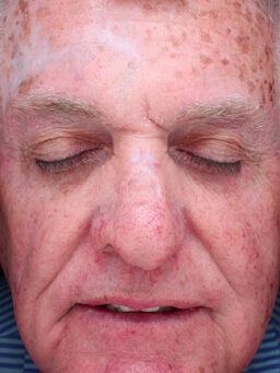 Case # 32 before photo