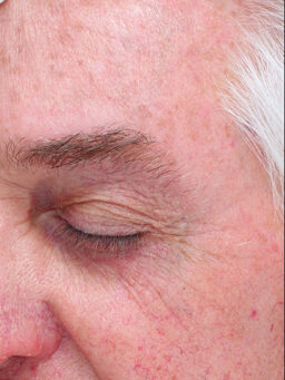 Case # 32 after photo