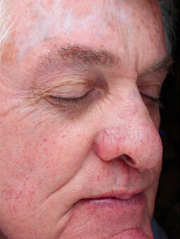 Case # 32 after photo