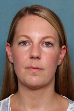 Case # 4 after photo