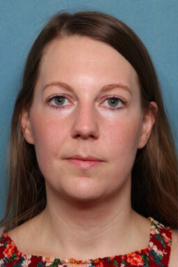 Case # 4 before photo