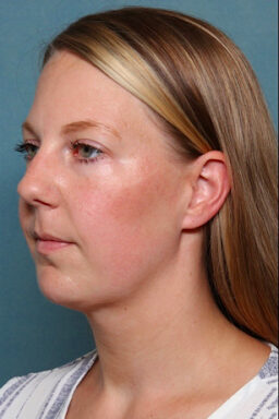 Case # 4 after photo