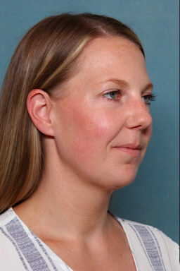 Case # 4 after photo