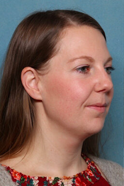 Case # 4 before photo