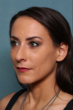 Case # 22 after photo