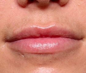 Case # 14 after photo