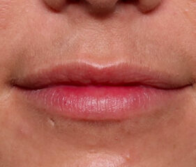 Case # 14 before photo