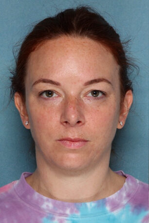 Case # 3 before photo