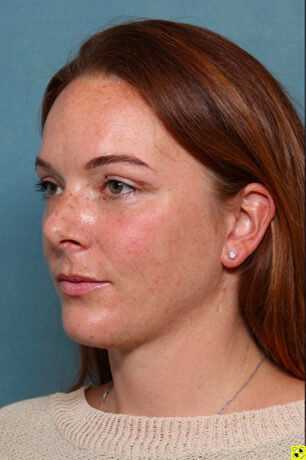 Case # 3 after photo