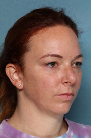 Case # 3 before photo