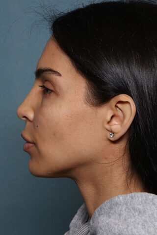 Case # 20 after photo