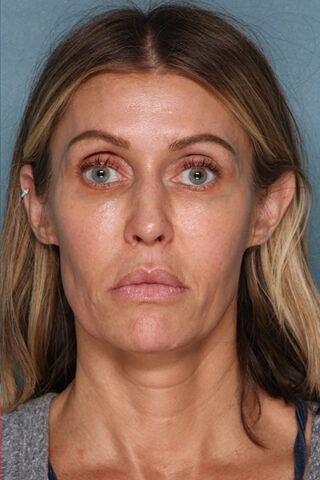 Case # 18 after photo