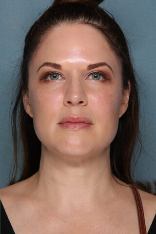 Case # 17 after photo