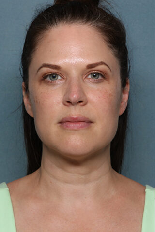 Case # 17 before photo