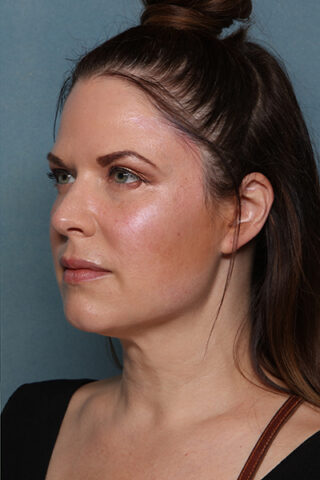 Case # 17 after photo