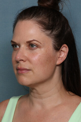 Case # 17 before photo