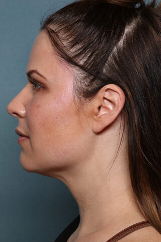 Case # 17 after photo