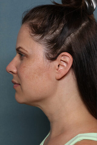 Case # 17 before photo