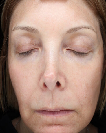 Case # 25 after photo