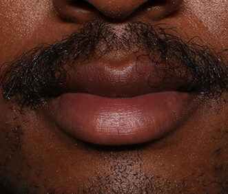 Case # 23 after photo