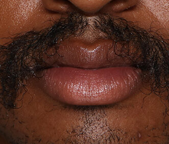 Case # 23 before photo