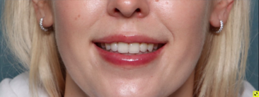 Case # 21 after photo