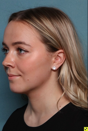 Case # 2 after photo