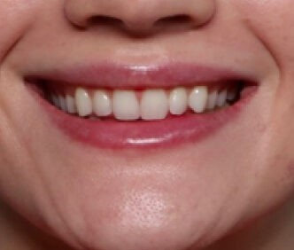 Case # 3 after photo