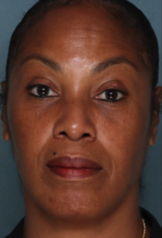 Case # 9 after photo