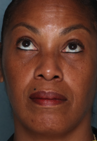 Case # 9 after photo