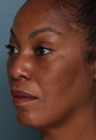 Case # 9 after photo