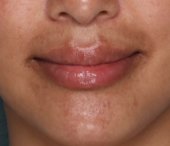 Case # 18 after photo