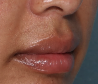 Case # 18 after photo