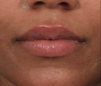 Case # 17 after photo