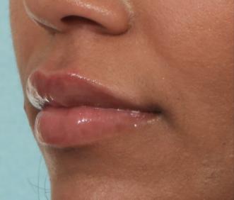 Case # 17 after photo