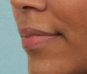 Case # 17 before photo