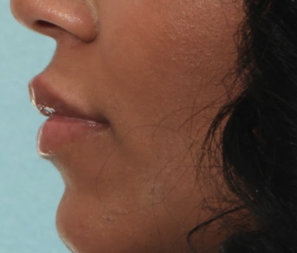 Case # 17 after photo