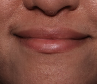 Case # 9 after photo