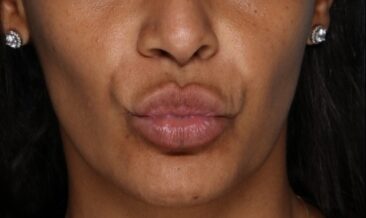 Case # 16 after photo