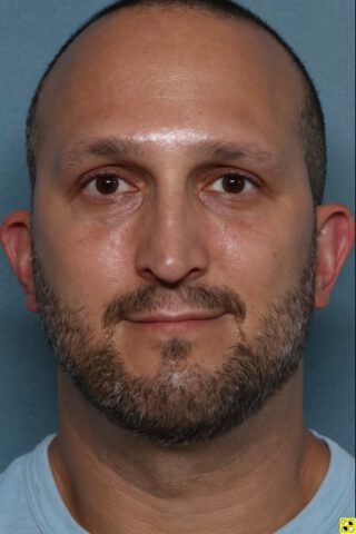 Case # 2 after photo