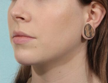 Case # 12 after photo