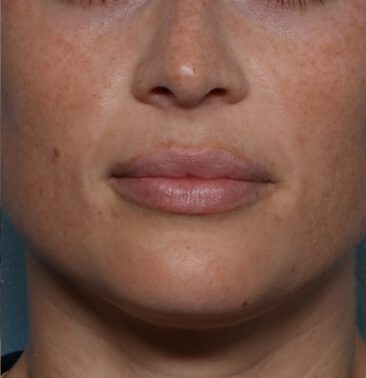 Case # 20 after photo