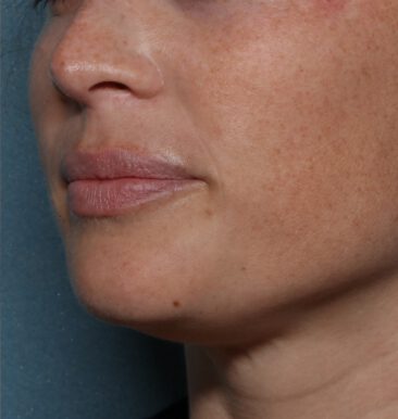 Case # 20 after photo