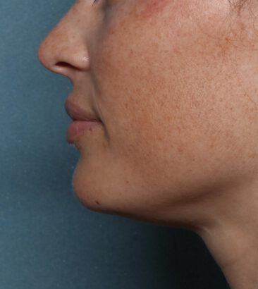 Case # 20 after photo