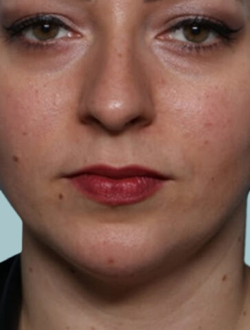 Case # 8 after photo