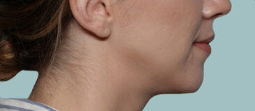 Case # 14 after photo