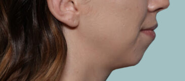 Case # 14 before photo